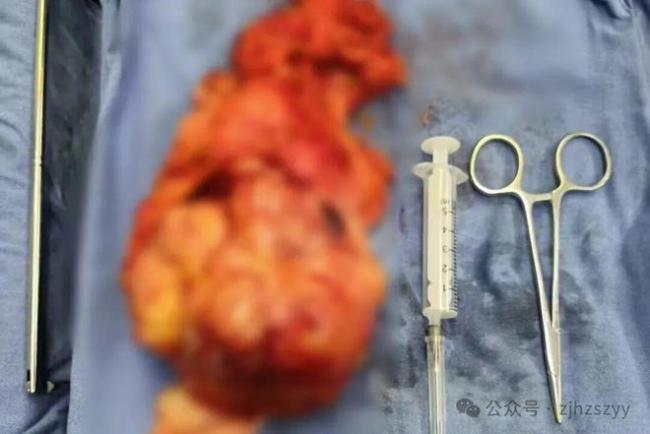 24岁女子胸部长出拳头大肿块 忽视身体信号险酿大祸