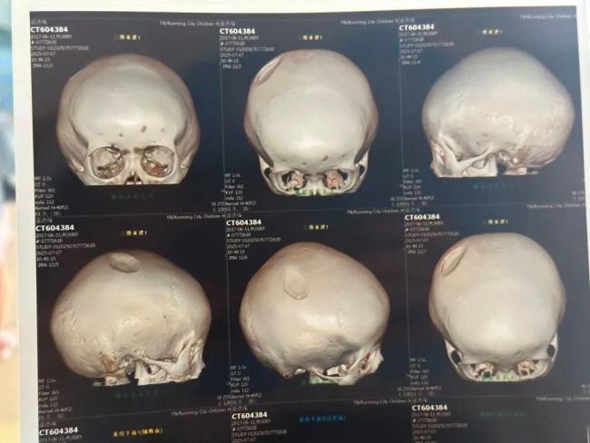 男子酒后误砸伤路过男童获刑