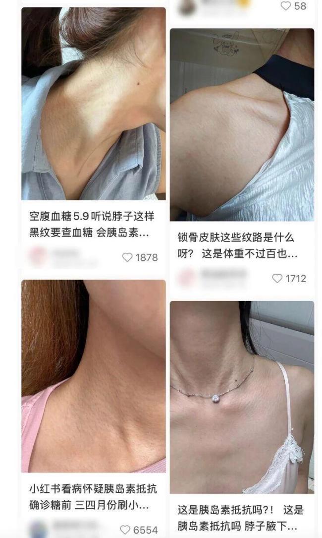 真的想问：脖子上一条条的“黑道道”，是胰岛素抵抗吗？不必太过担心