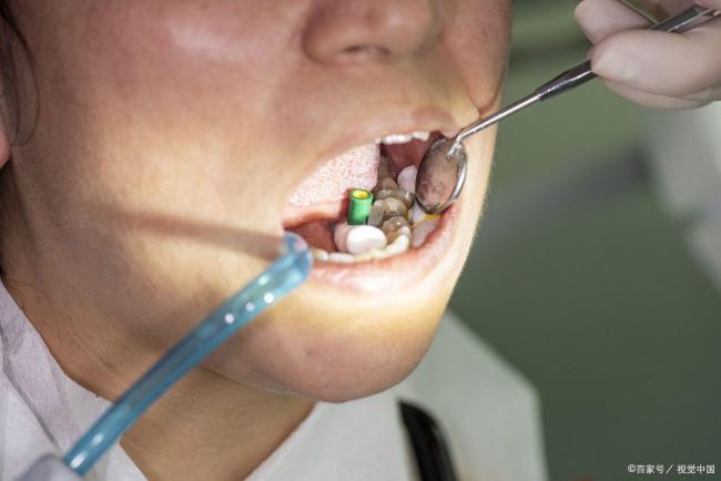 拔智齿会瘦的的确原因 科学融会误区