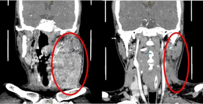 男人从口腔溃疡到舌癌搬动仅2个月 槟榔成罪魁罪魁