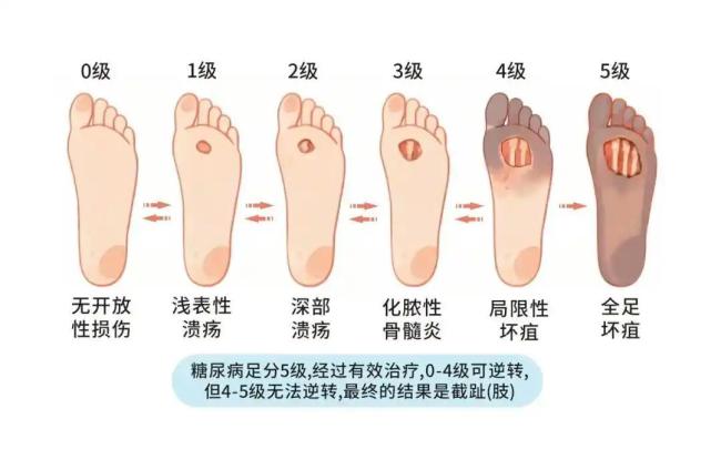 超一半人不知道自己得了糖尿病 忽视症状风险大