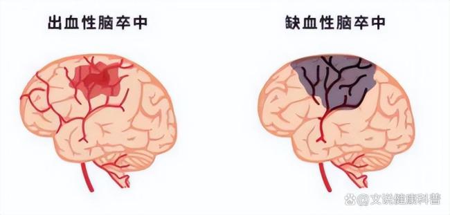 120不仅是急救电话也是救命口诀 中风识别与自救秘籍