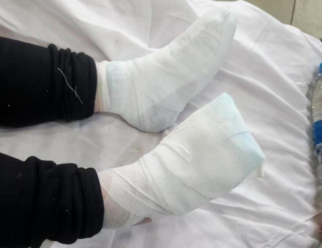 女大学生东北冻伤三根手指或截肢 意外晕倒雪地引发关注