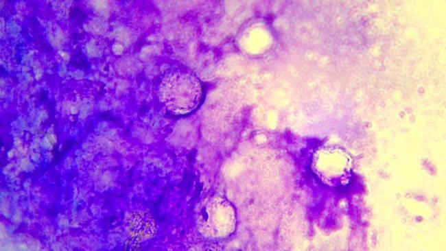 女子感染食脑虫眼球差点不保 角膜移植挽救视力