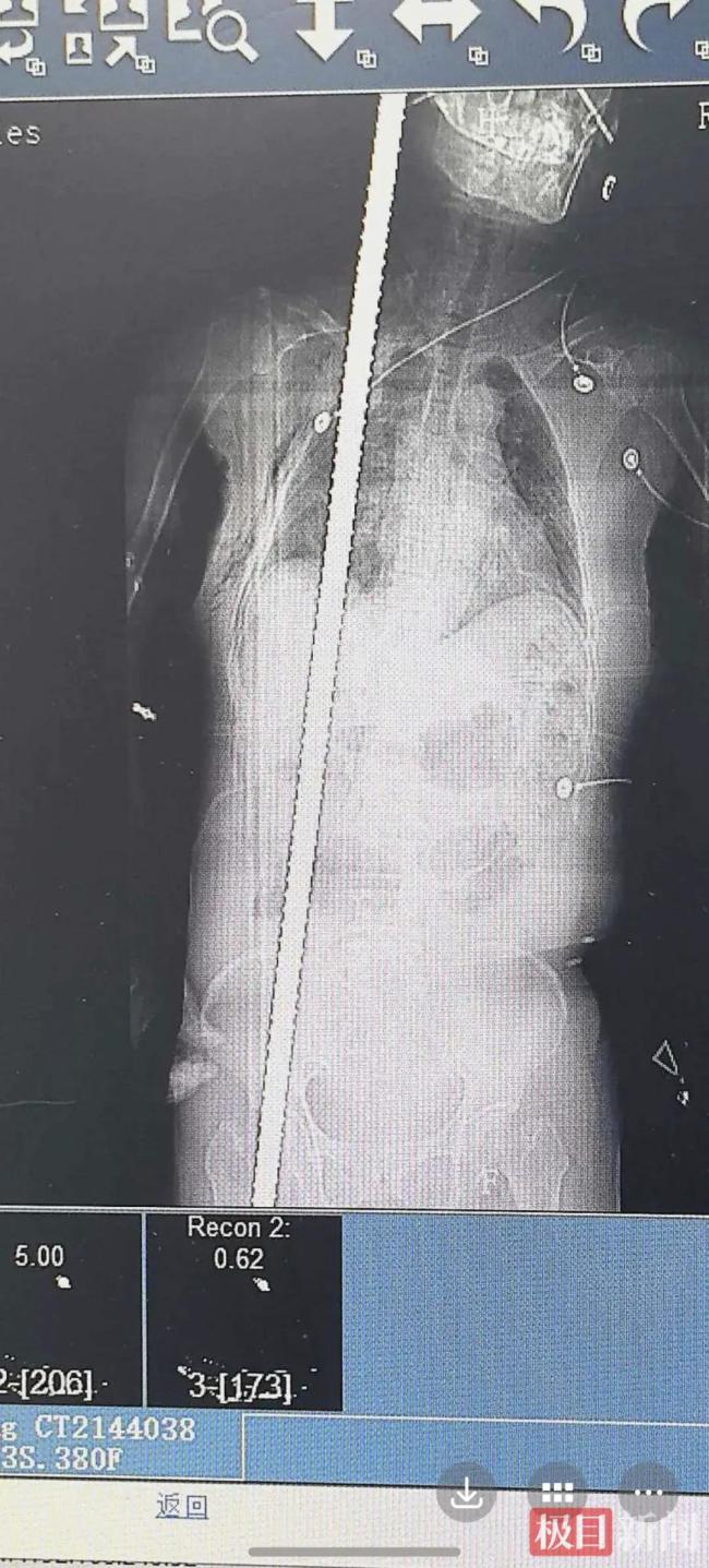 钢筋从天降络续女子总共胸腹腔 8小时存一火救助创造古迹