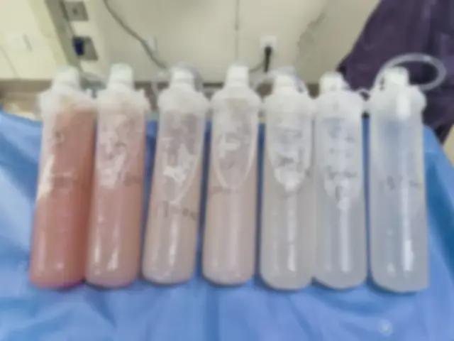 装修工胸闷不见好肺里竟满是牛奶糊 罕见病终确诊