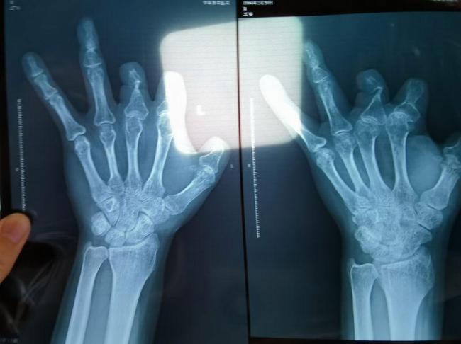 单价1.68万的器材植入体内后消失 手术器械疑云