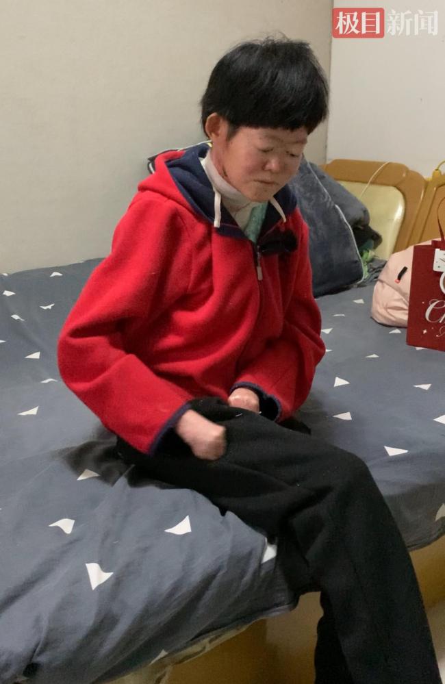 24岁蝴蝶宝贝病情严重时曾瘫痪在床 坚强面对罕见病挑战