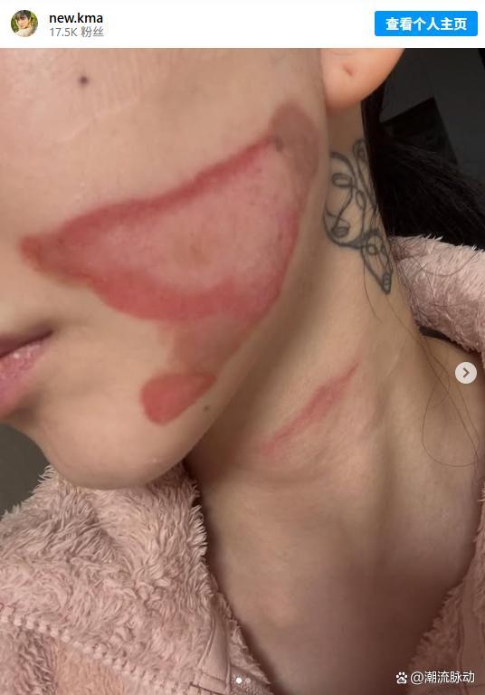 权珉娥医好意思后毁容 医好意思事故激发烧议