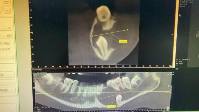 女孩埋伏牙压迫5颗恒牙牙根 医生提醒