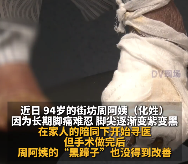 94岁老人患腿梗整条腿变黑 
