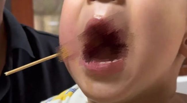 男孩吃糍粑时被签子扎穿脸颊 景区迅速反应获赞