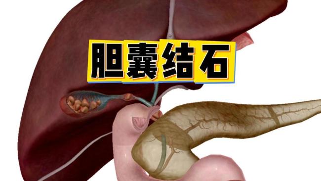 女子过年大鱼大肉致重症胰腺炎 节日饮食需严慎