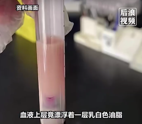 28岁小伙长期吃炸鸡抽出猪油汤血 医生提醒