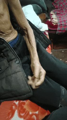 多科协作为电锯伤患者保肢 绿色通道开启生命救援