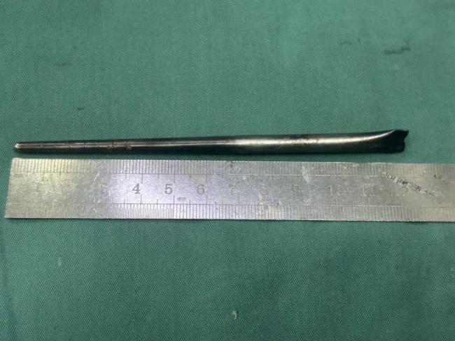 男子误吞12厘米筷子忍了8年才取出 异物感终难忍就医