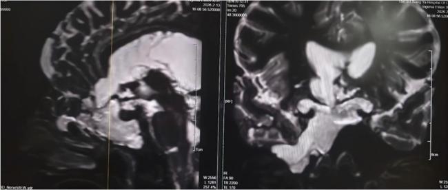 女子流清鼻涕4年竟是脑子漏水