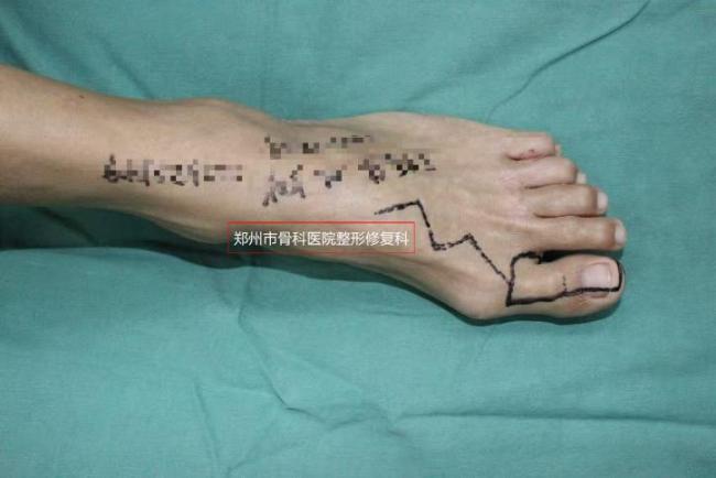 男子手指被绞碎医生为其接上脚趾头 成功恢复手部功能
