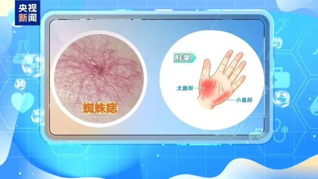 这些信号可能是你的肝在求救 警惕肝脏“报警”信号