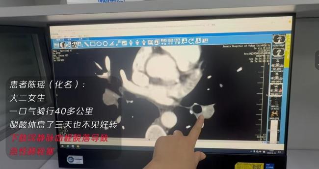 运动后出现这种症状别轻视 警惕急性肺栓塞