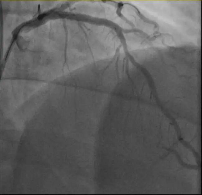 男子打10分钟羽毛球后心梗 剧烈运动成诱因