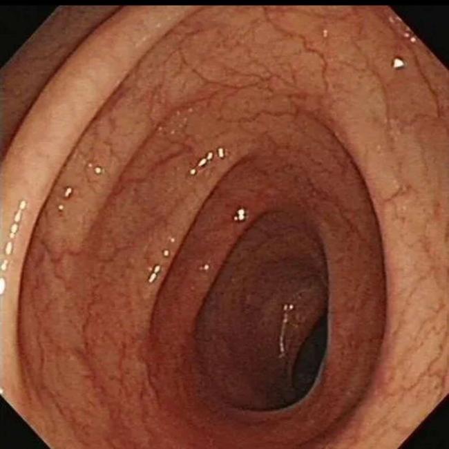 女子便秘10年被切30厘米肠管