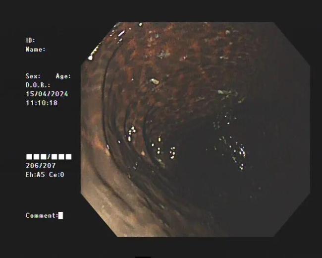 女子便秘10年被切30厘米肠管 长期滥用通便茶的代价