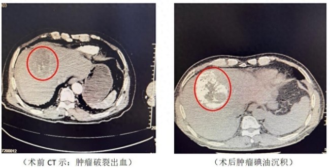 七旬奶奶跳广场舞太激烈致肿瘤破裂