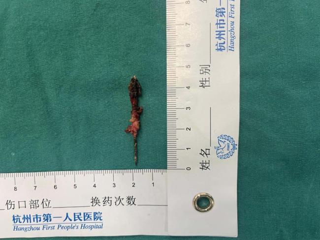 男子体检发现胸腔藏了一根缝衣针 十余年“与针共存”奇迹