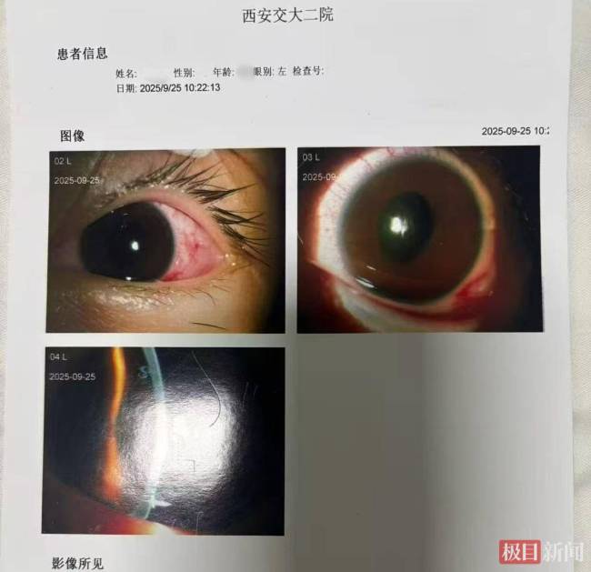 初中生遭班主任扔戒尺砸伤左眼 家长要求公开调查结果