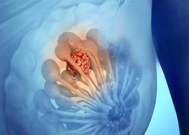 乳腺结节有3个特征更易癌变