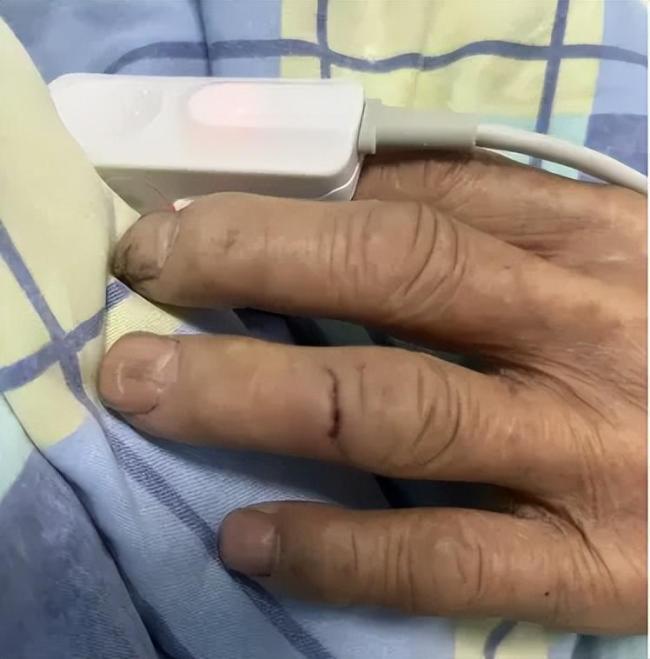 男子遭老鼠咬10天后确诊鼠咬热