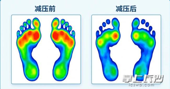 33岁“糖友”脚底反复溃烂