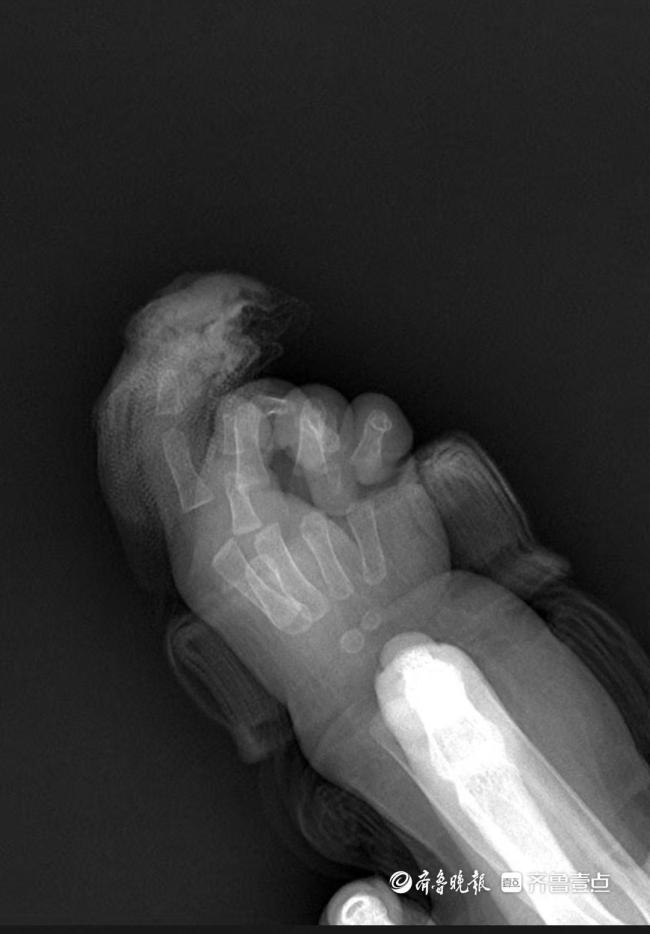 “绣花式”手术为7月龄女婴断指再接 显微镜下极限挑战