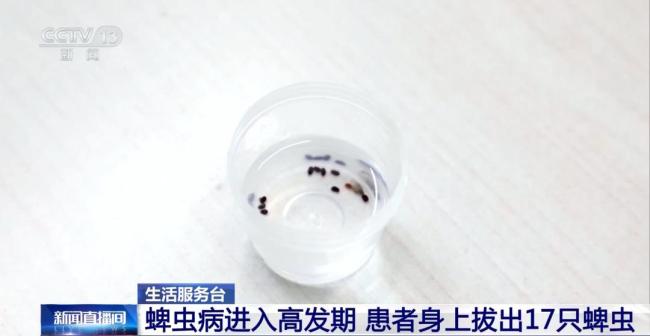 医生从患者身上拔出17只蜱虫 蜱虫病需警惕