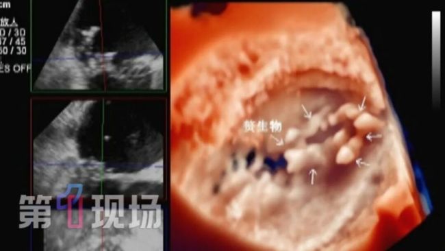 男子低烧暴瘦一查心脏竟有个马蜂窝 细菌炸弹藏身心脏
