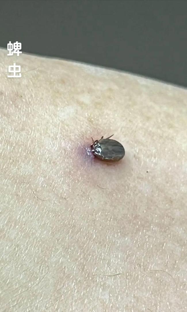 这类虫子出没高峰期咬一口或致命 被咬了该怎么处理