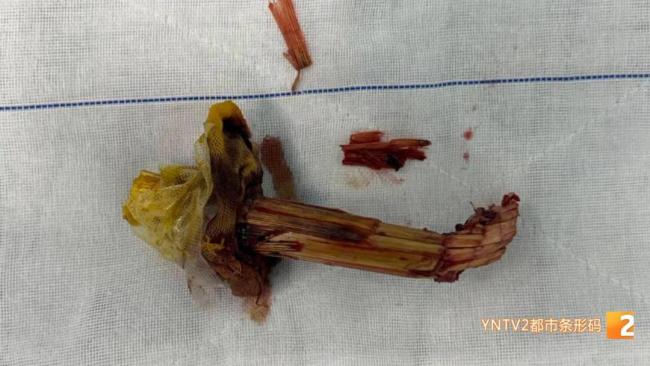 男子摔倒被玉米秆从耳后刺入7厘米 紧急手术成功取出