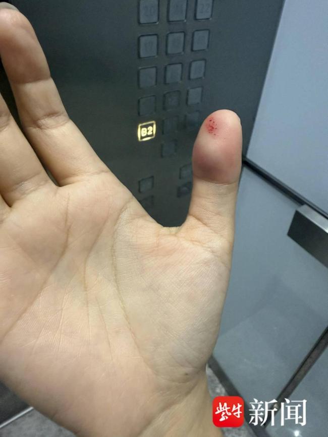 女子被小米SU7电吸门夹手指致骨折 瞬间剧痛难忍