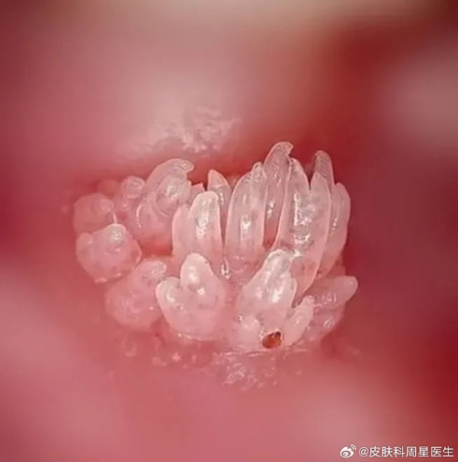男子手上长肉芽剪掉又长疑感染HPV 拖延不治变花戒
