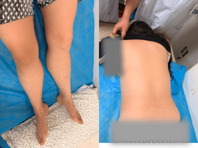 大姐治腰腿痛意外治好顽固银屑病