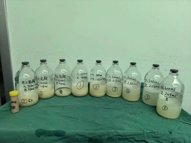 女童咳嗽2个月肺里洗出3升
