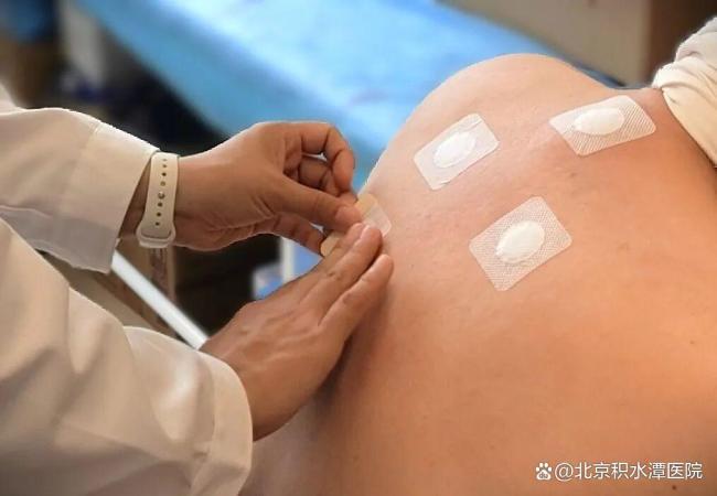 北京积水潭医院三伏贴开启预约 三个院区均可预约就诊