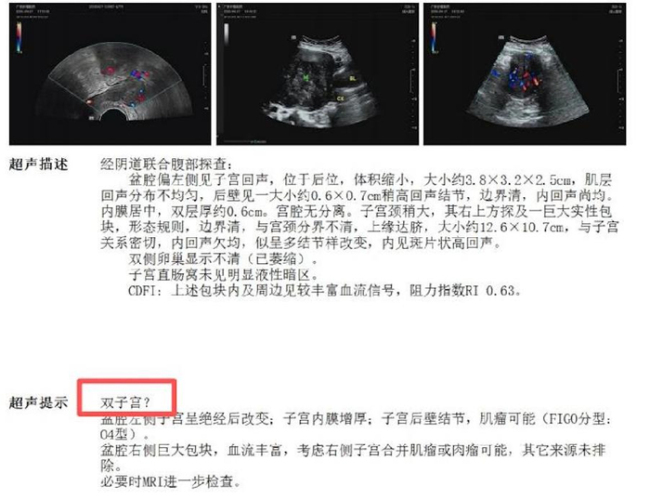 阿姨绝经7年异常出血查出双子宫