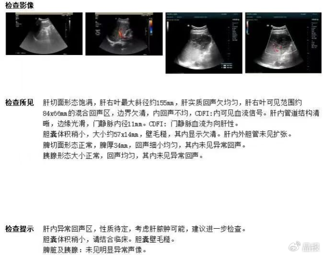 反复高烧4天不退,原是肝里长了“拳头大”脓包