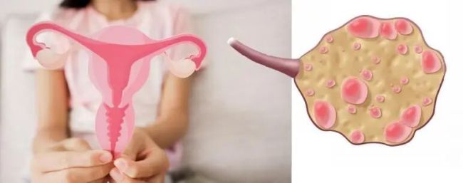影响上亿女性的病更名了 多囊更名为PMOS