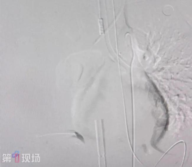 女子漂流呛水后吐血被确诊罕见病 命悬一线终获救