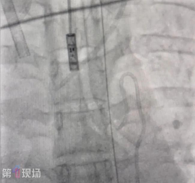 女子漂流呛水后吐200毫升血进ICU 命悬一线获救