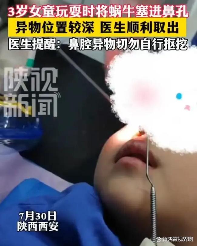 女童好奇塞蜗牛进鼻腔全麻取出